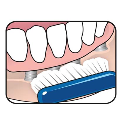 TePe Implant Orthodontic Brush™ 126