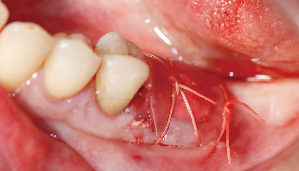 Dressing covering a sutured site in a guided bone regeneration (GBR) example