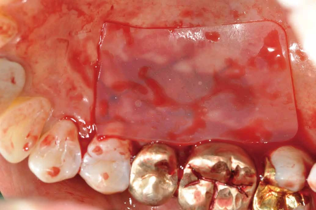 Dressing covering a palatal site in a free gingival graft example