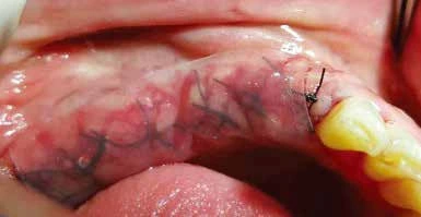 Dressing covering a sutured site in an implantation example
