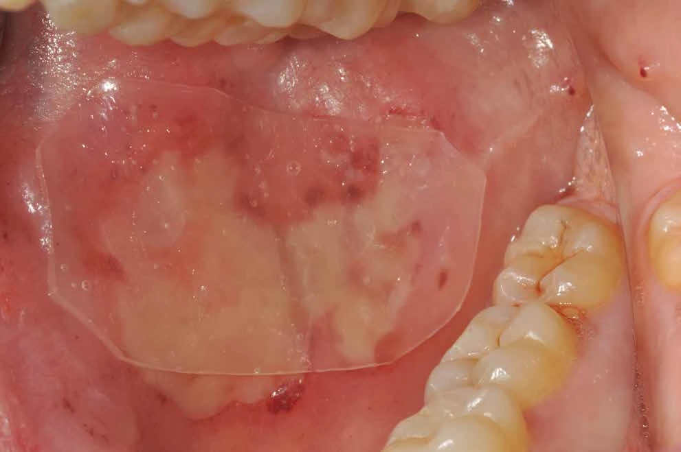 Ora-Aid dressing covering an oral wound