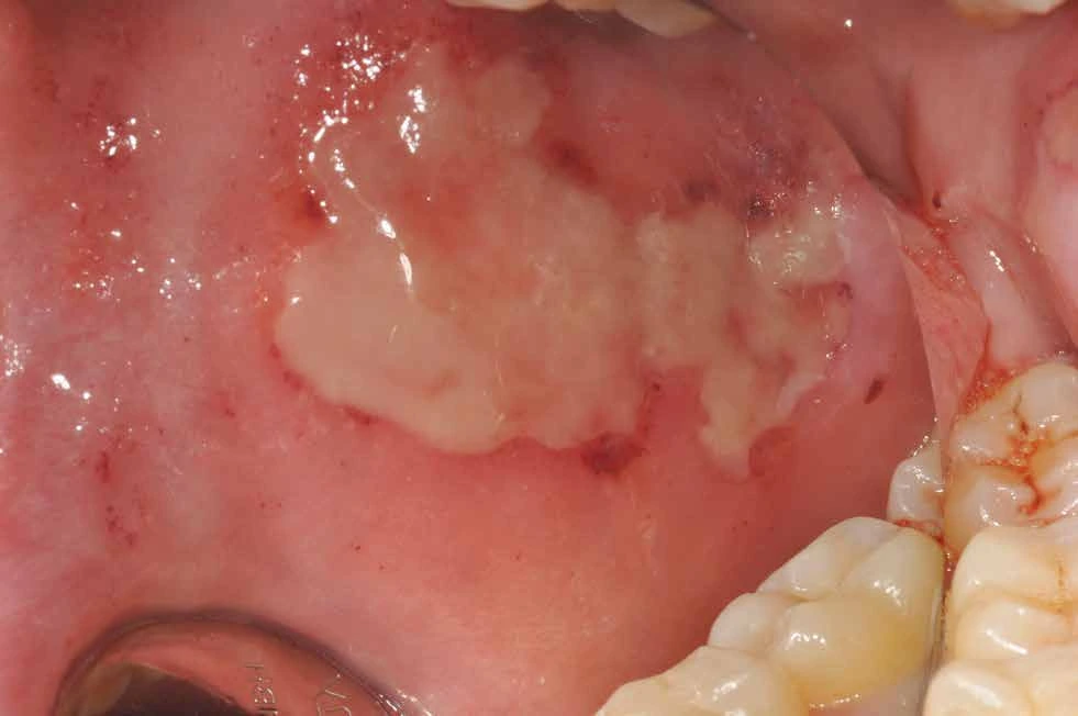 Oral wound before dressing placement